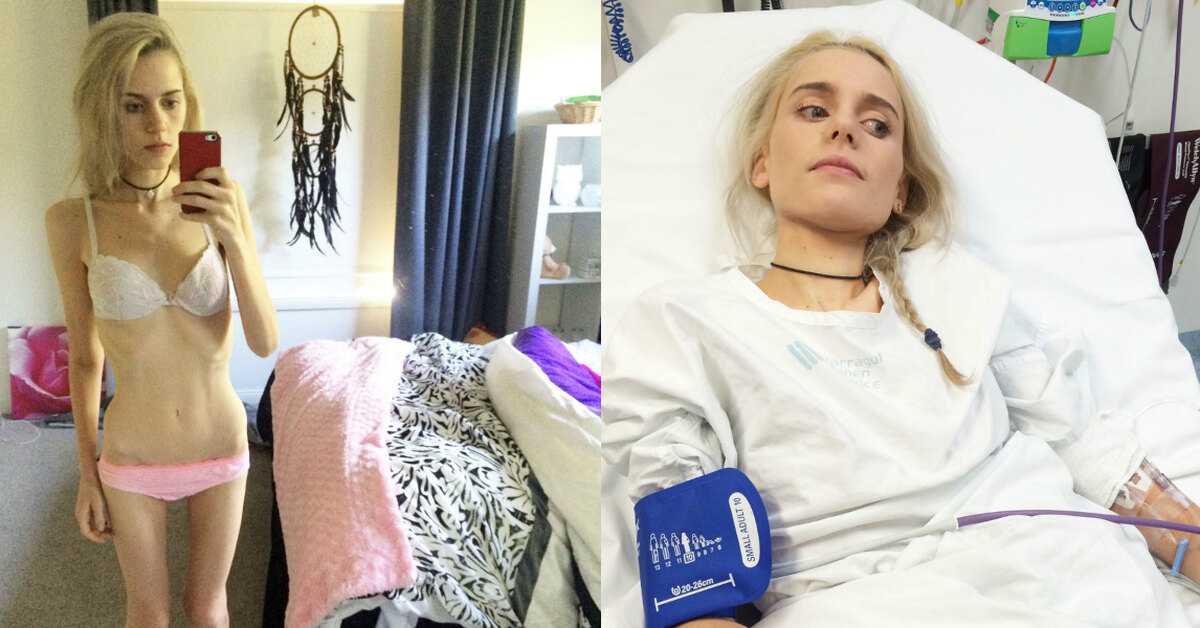 20+ звезд, которые почувствовали на себе, что такое анорексия