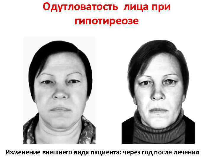 Аллергия на краску для волос. отек лба - вопрос аллергологу - 03 онлайн