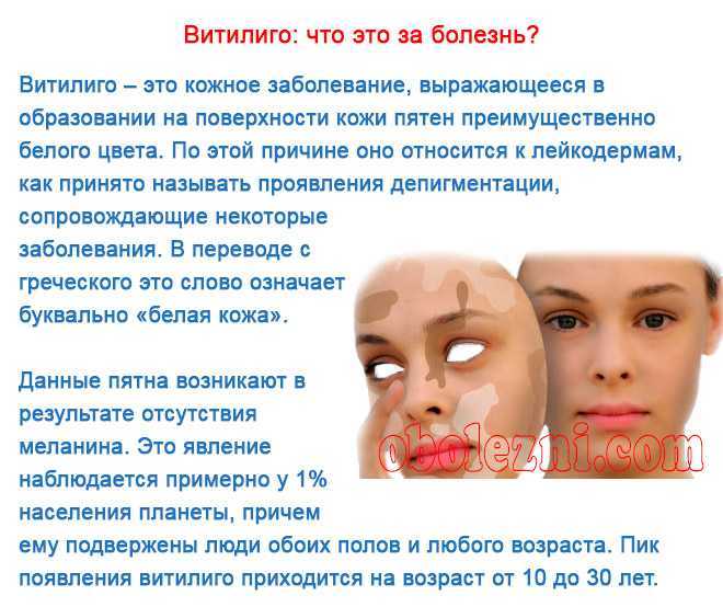 Витилиго: фото начальной стадии, причины и лечение