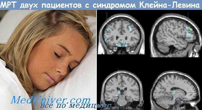Синдром клейне-левина (спящей красавицы): симптомы, как лечить