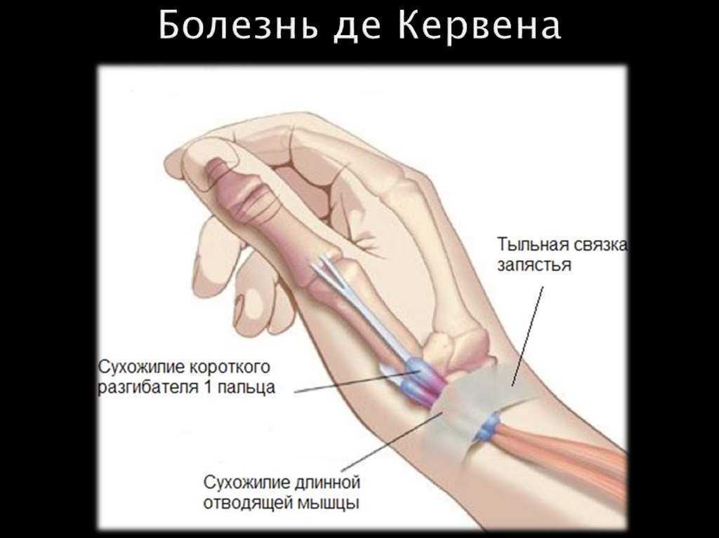 Эффект запястья как сделать